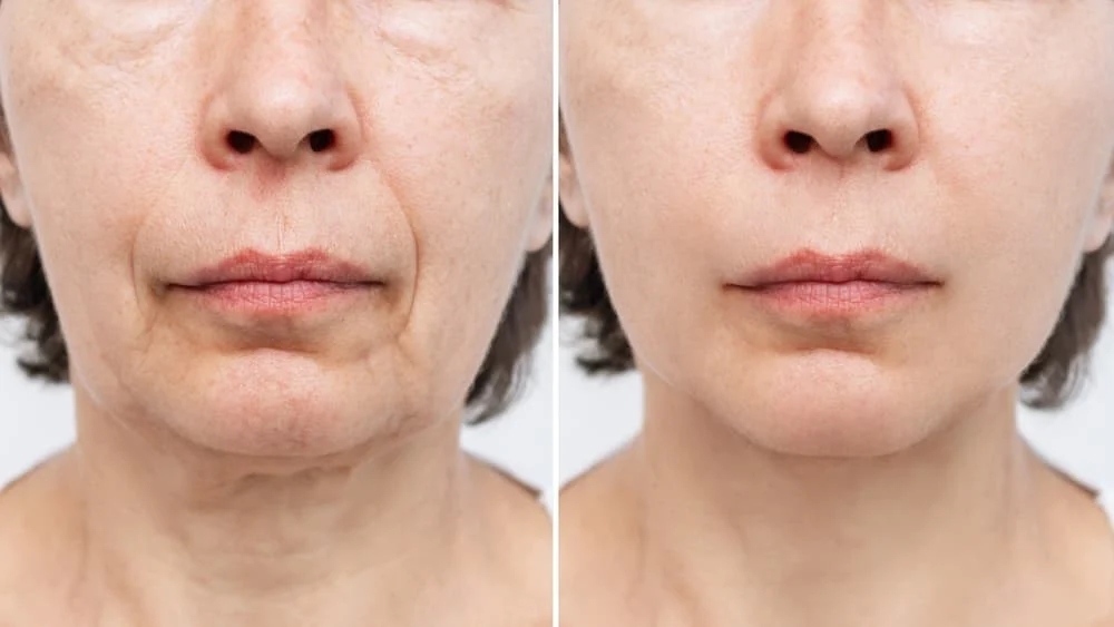 The Complete Guide to Facelift Surgery: Everything You Need to Know